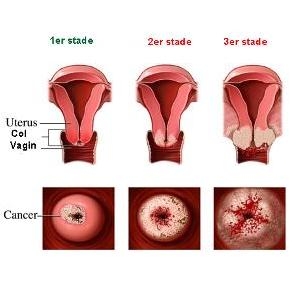 poza despre cancerul uterin